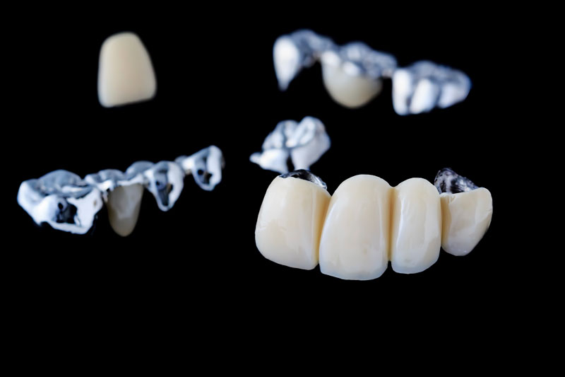 Dental Bridges in Lancaster